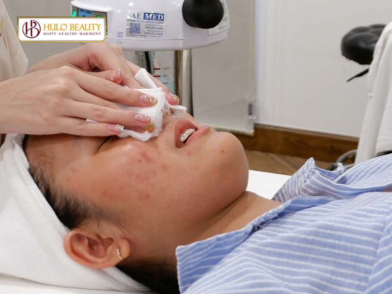 Bước 1: Vệ sinh da trong điều trị sẹo