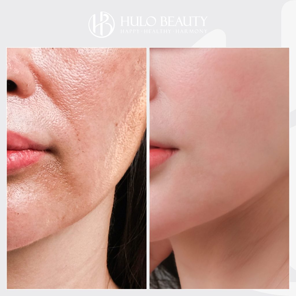 Khách hàng cảm thấy hài lòng sau khi trải nghiệm dịch vụ Light Peel QPlus