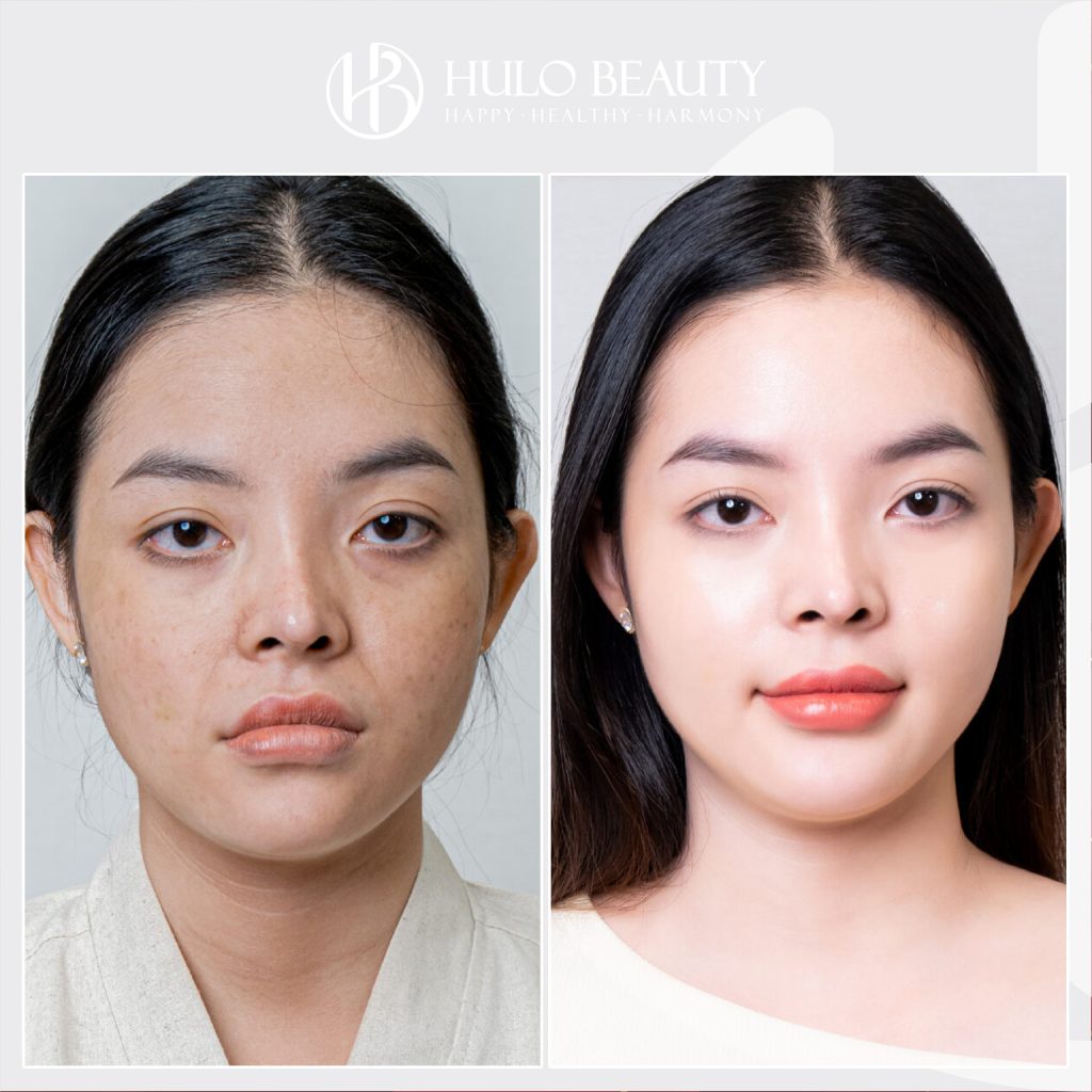 Light Peel QPlus mang lại hiệu quả rõ rệt cho làn da khách hàng