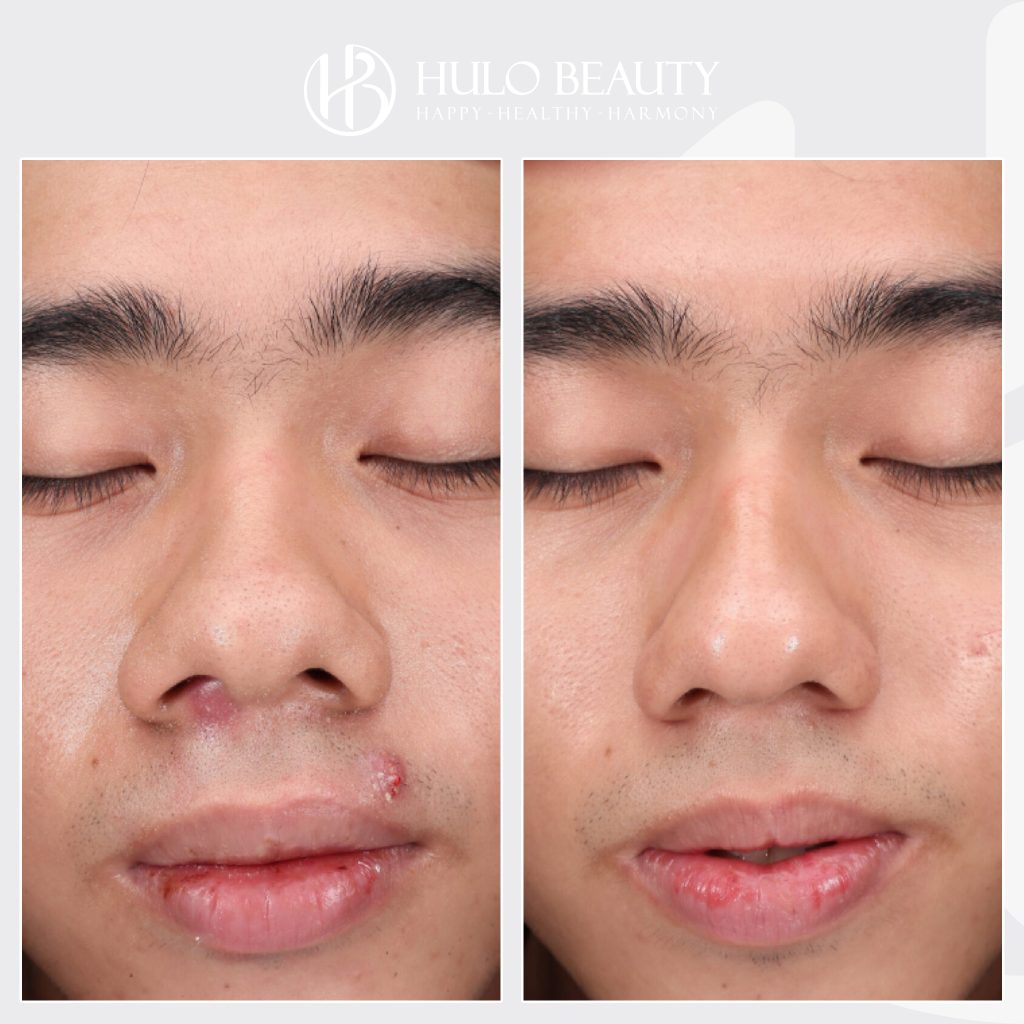 Khách hàng sau liệu trình điều trị mụn công nghệ cao tại Hulo Beauty