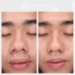 Khách hàng sau liệu trình điều trị mụn công nghệ cao tại Hulo Beauty