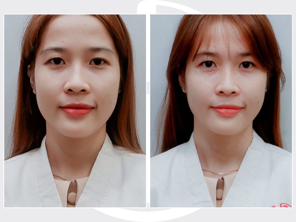 Khách hàng sau khi thực hiện dịch vụ Daily Skin tại Hulo Beauty