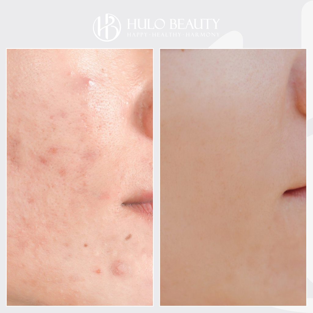 Khách hàng sau liệu trình điều trị mụn công nghệ cao tại Hulo Beauty