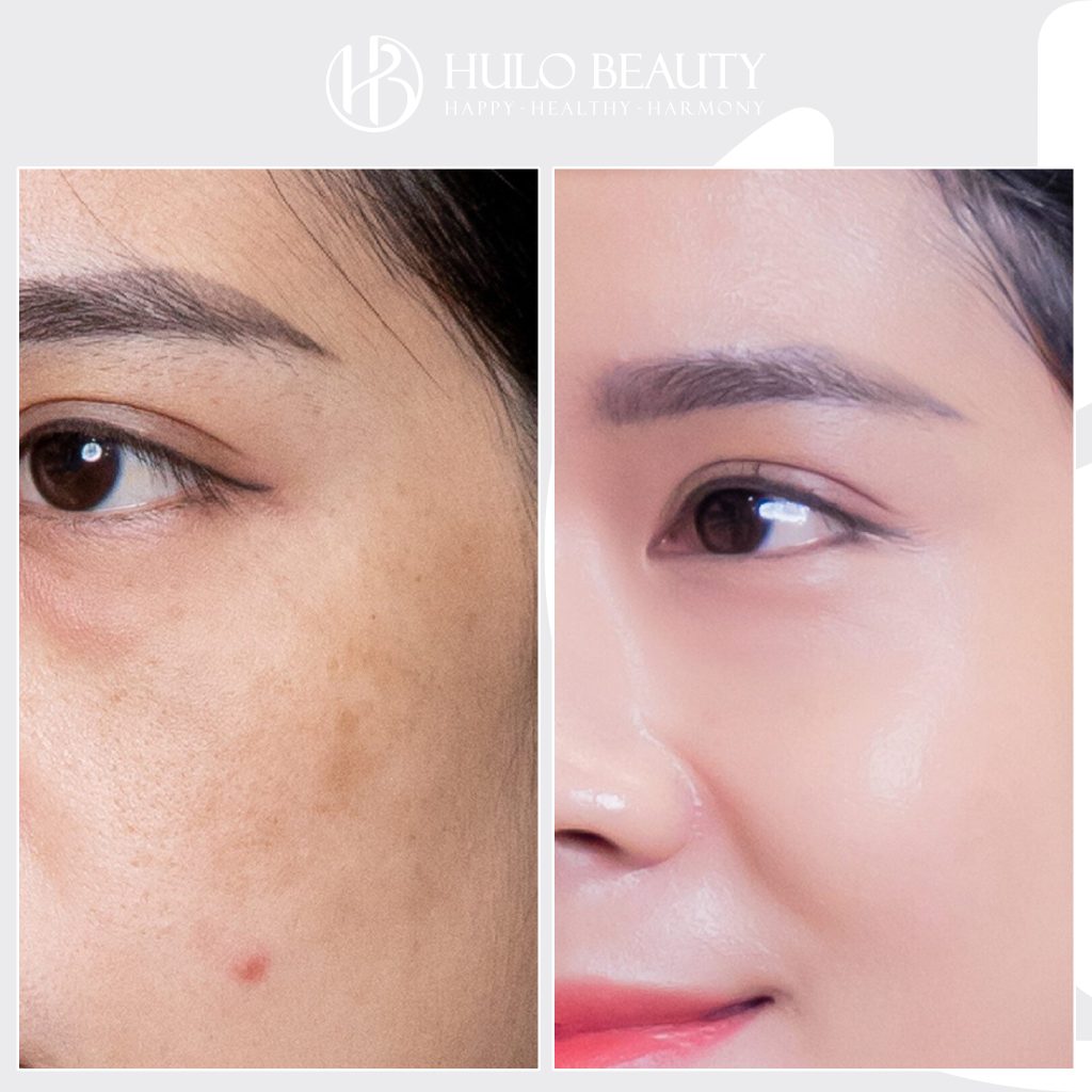 Hình ảnh của khách hàng sau liệu trình Medilasma