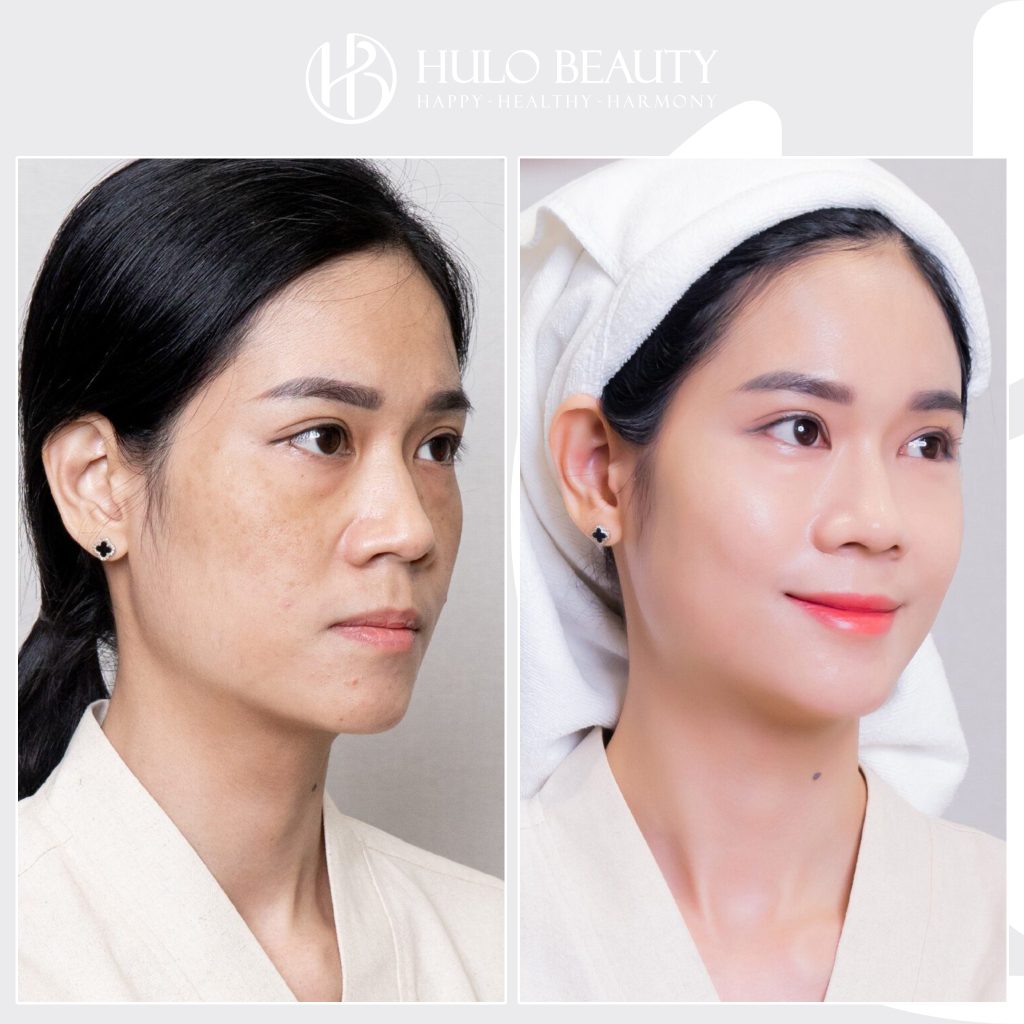 Loại bỏ đến 90% nám sau liệu trình