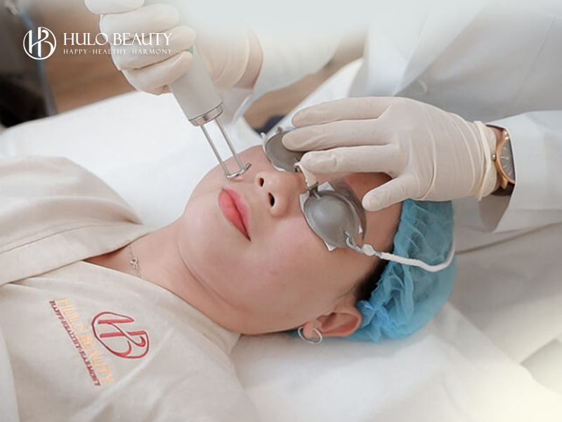Bước 4: Loại bỏ hắc sắc tố với laser Châu Âu