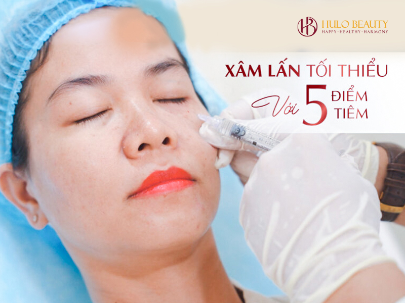 Xâm lấn tối thiểu với 5 điểm tiêm